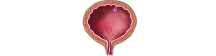 New EAUN guidelines to benefit bladder cancer patients